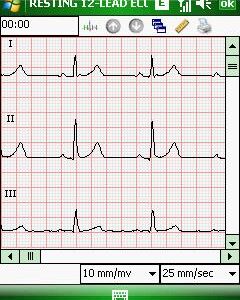 ECG SOS Pro 12 pistes sur Telephone Portable